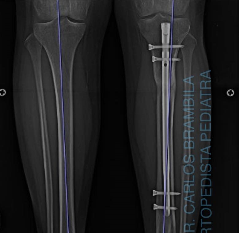 fractura de tibia