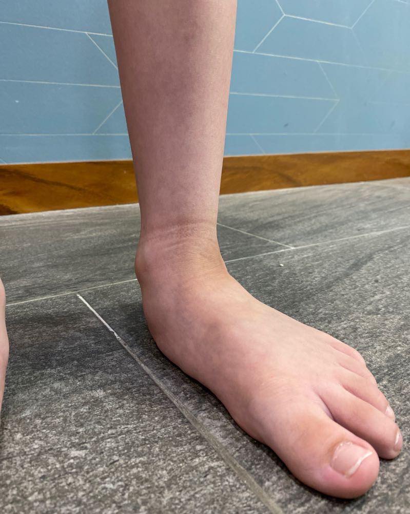 pie plano limitacion 3