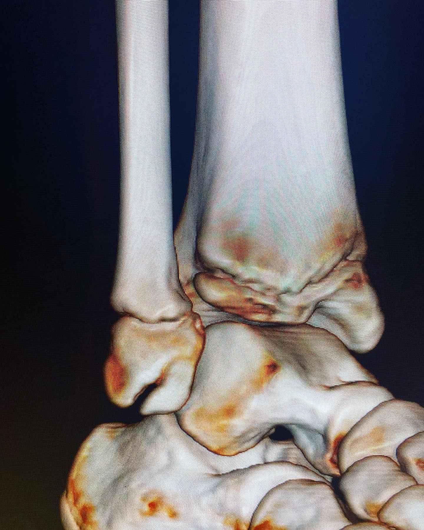 fractura de tobillito 3
