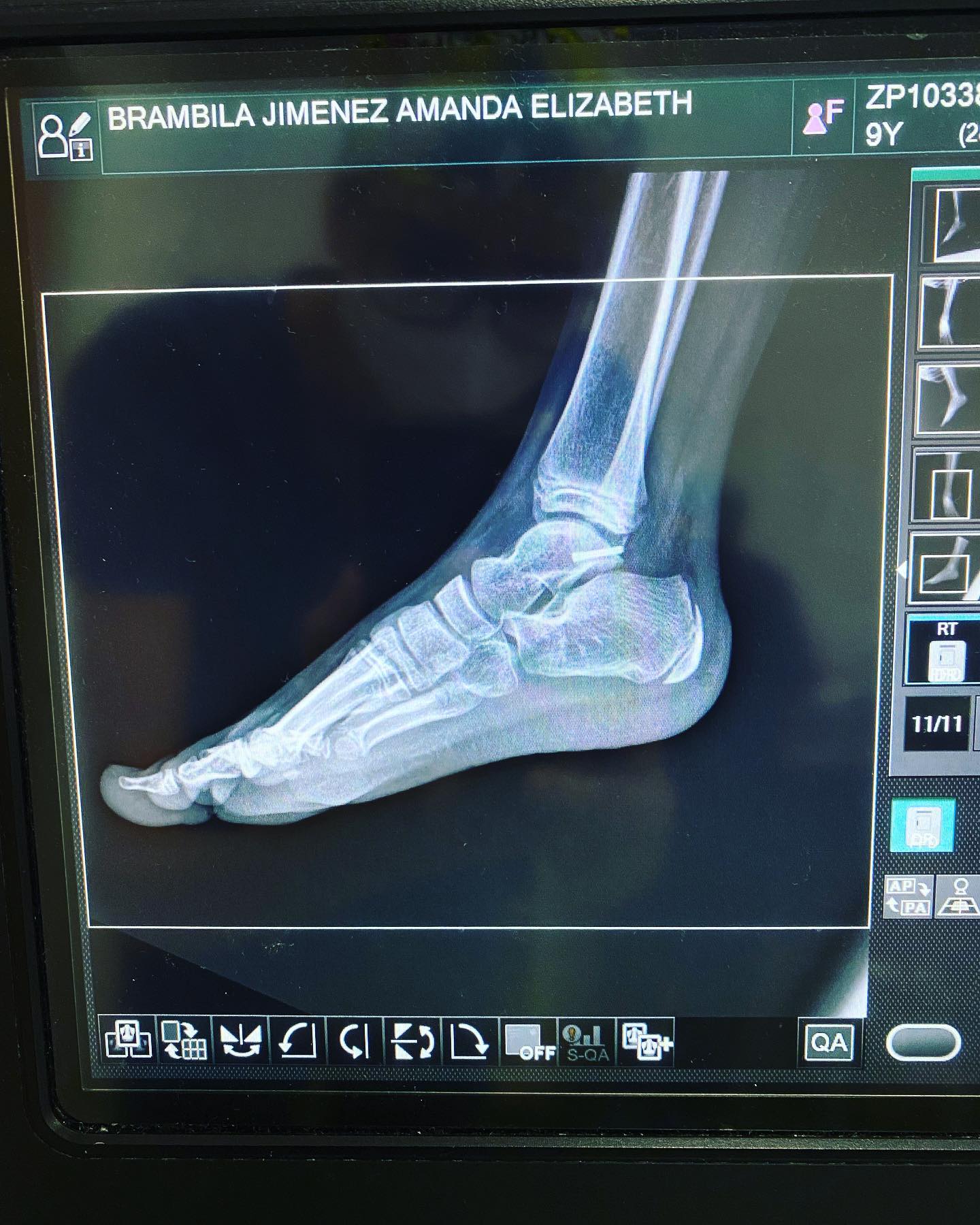 fractura de tobillito 6