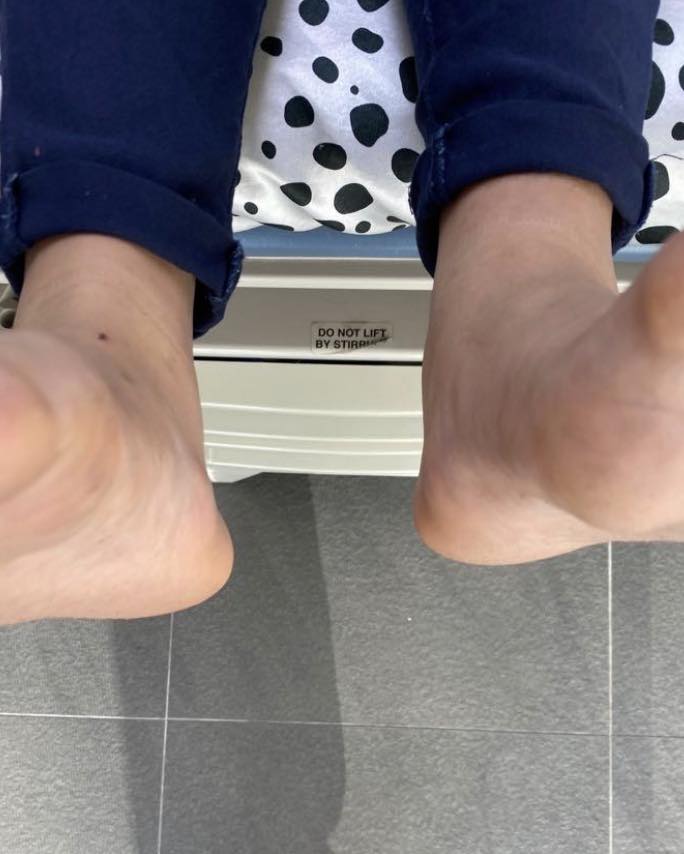 fractura de tibia 2