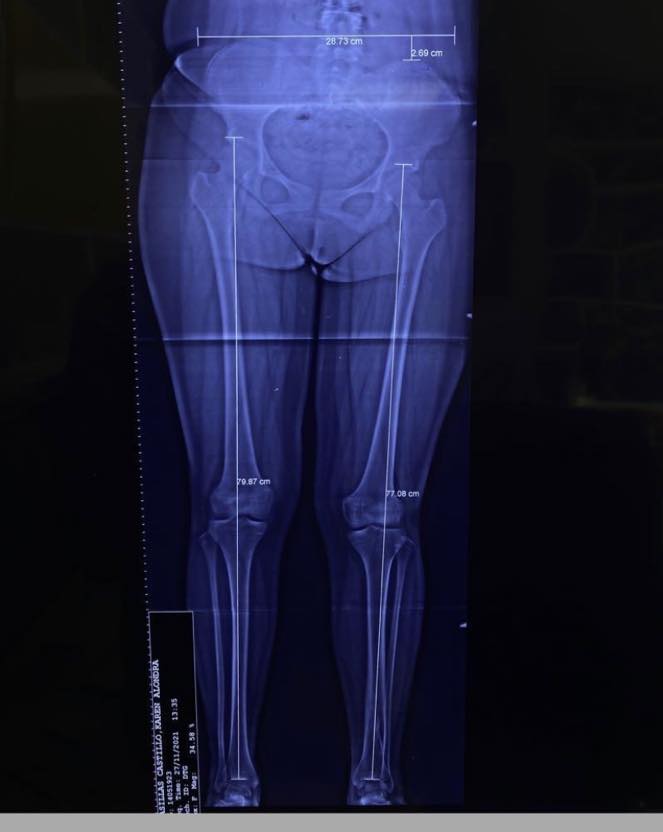 fractura de tibia 3