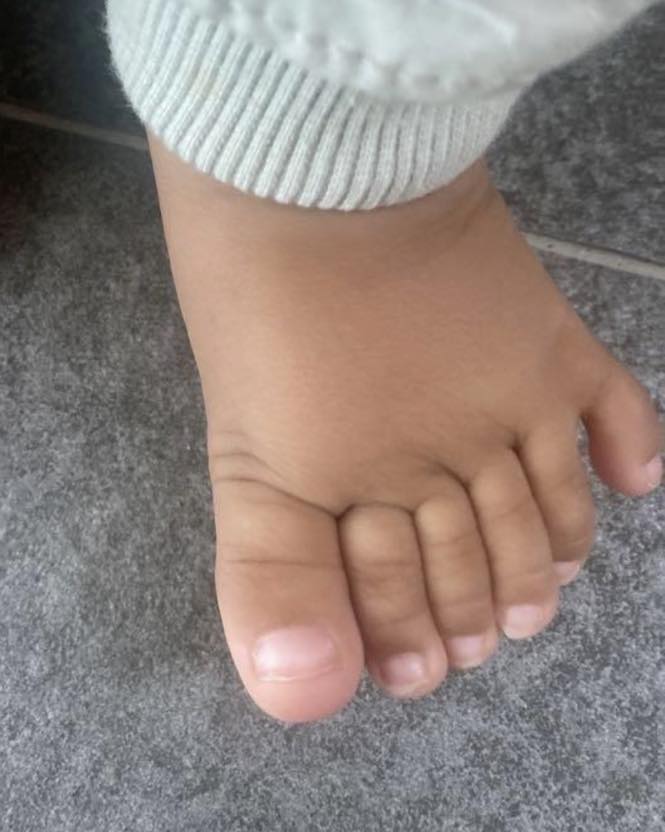 Polidactilia  3