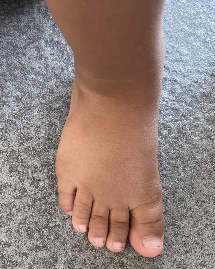 Polidactilia  4