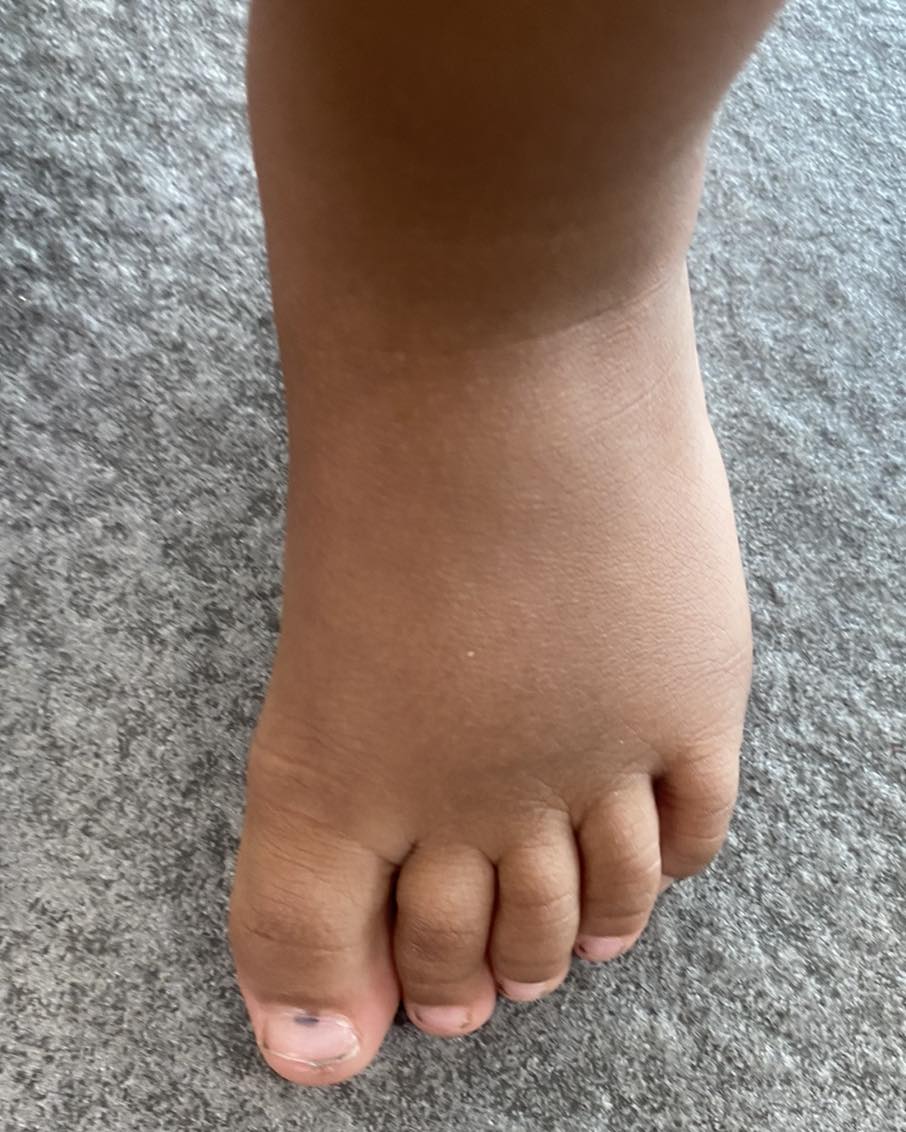 Polidactilia  5