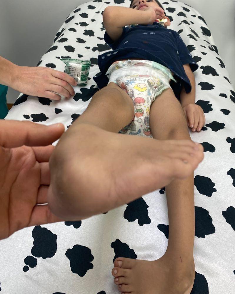 Atrogriposis con cadera luxada 3