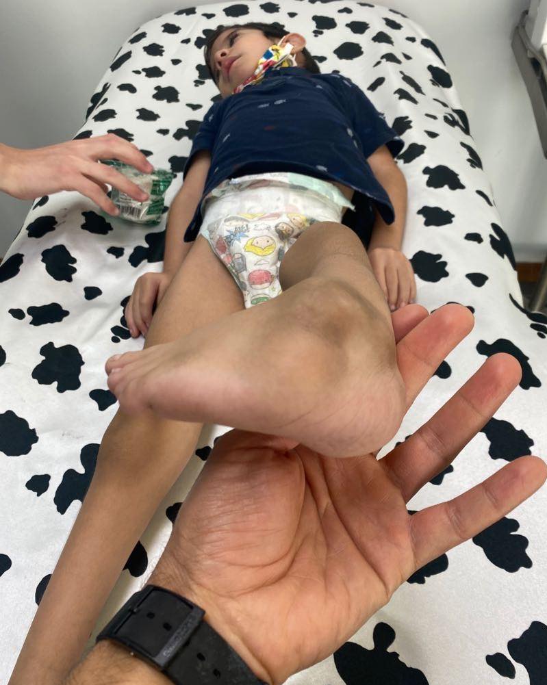 Atrogriposis con cadera luxada 4