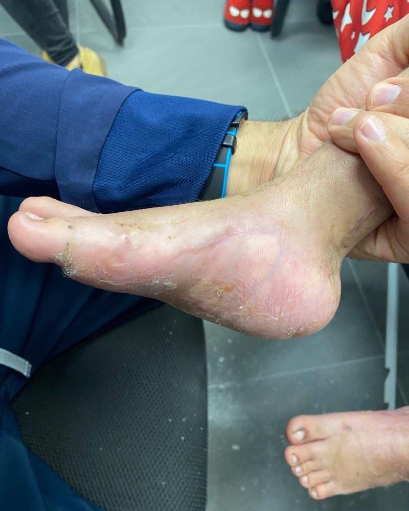 Atrogriposis con cadera luxada 5