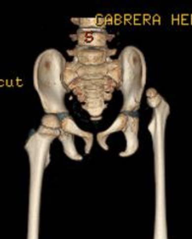 Atrogriposis con cadera luxada 8