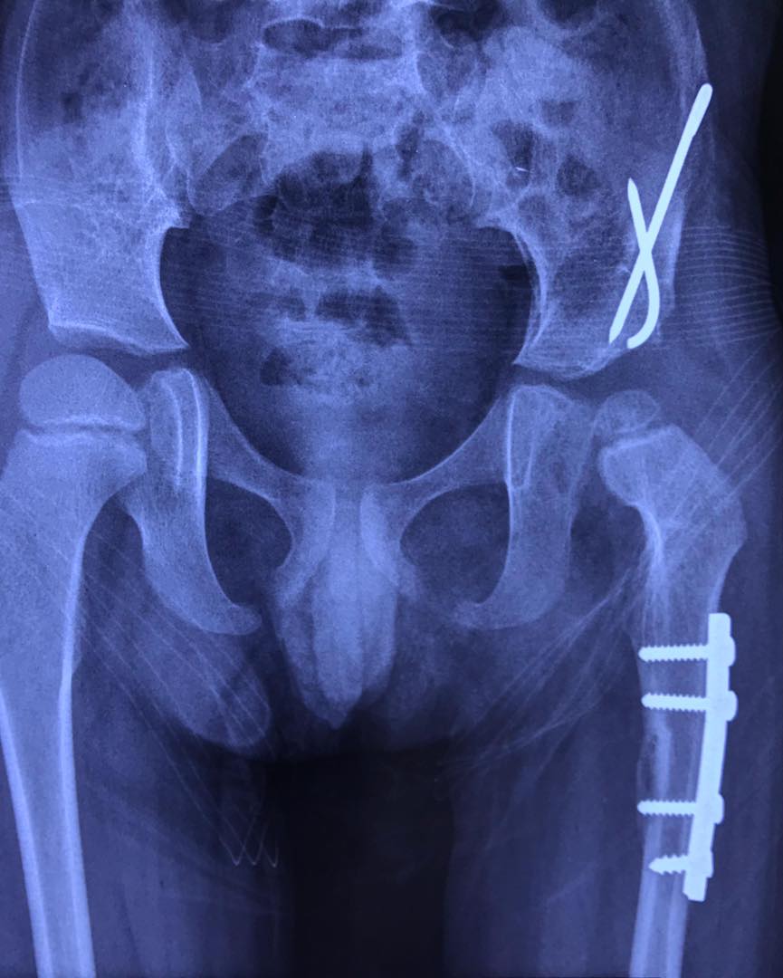 Atrogriposis con cadera luxada 9